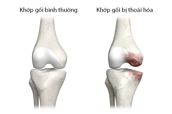 Điều trị bệnh thoái hóa khớp gối như thế nào?- Ảnh 1.