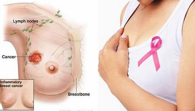 Béo phì lúc trẻ ảnh hưởng đến tuổi thọ của người ung thư vú- Ảnh 1. Béo phì lúc trẻ ảnh hưởng đến tuổi thọ của người ung thư vú- Ảnh 1.