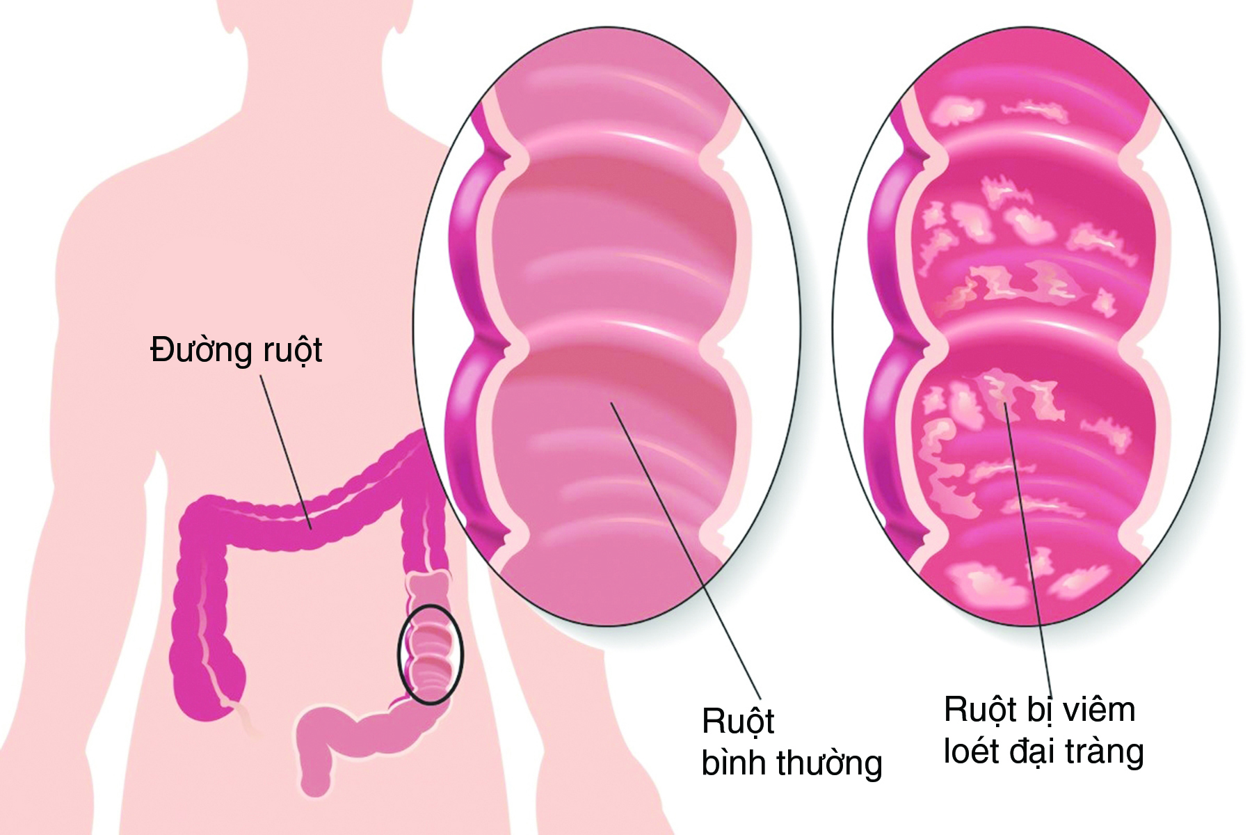 Viêm đại tràng mạn tính có nguy hiểm không?- Ảnh 1.