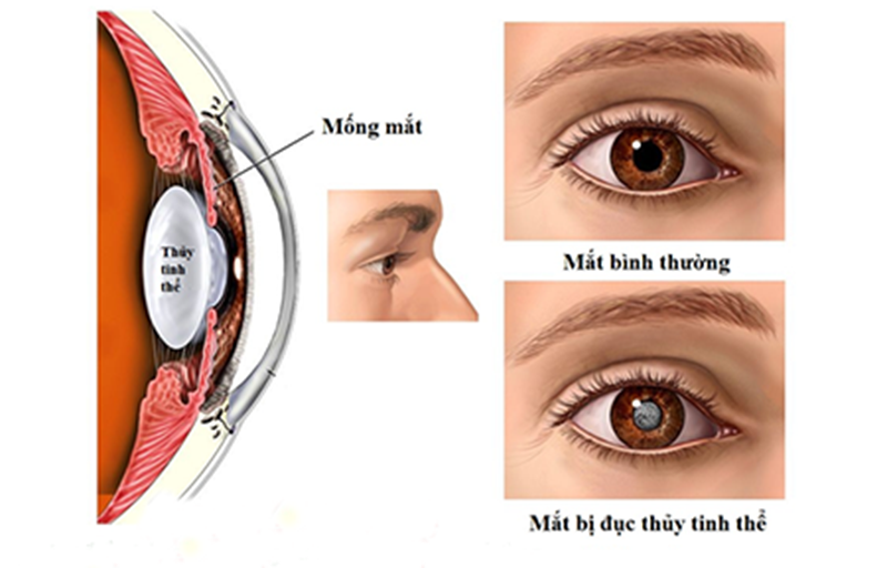 Nguyên nhân gây đục thủy tinh thể - Ảnh 1. Nguyên nhân gây đục thủy tinh thể - Ảnh 1.