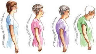 Chế độ ăn có ích với người gù cột sống- Ảnh 1. Chế độ ăn có ích với người gù cột sống- Ảnh 1.