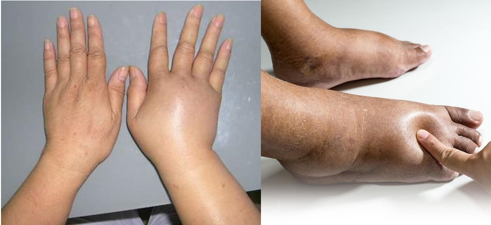 Phù là dấu hiệu của bệnh gì?- Ảnh 1. Phù là dấu hiệu của bệnh gì?- Ảnh 1.