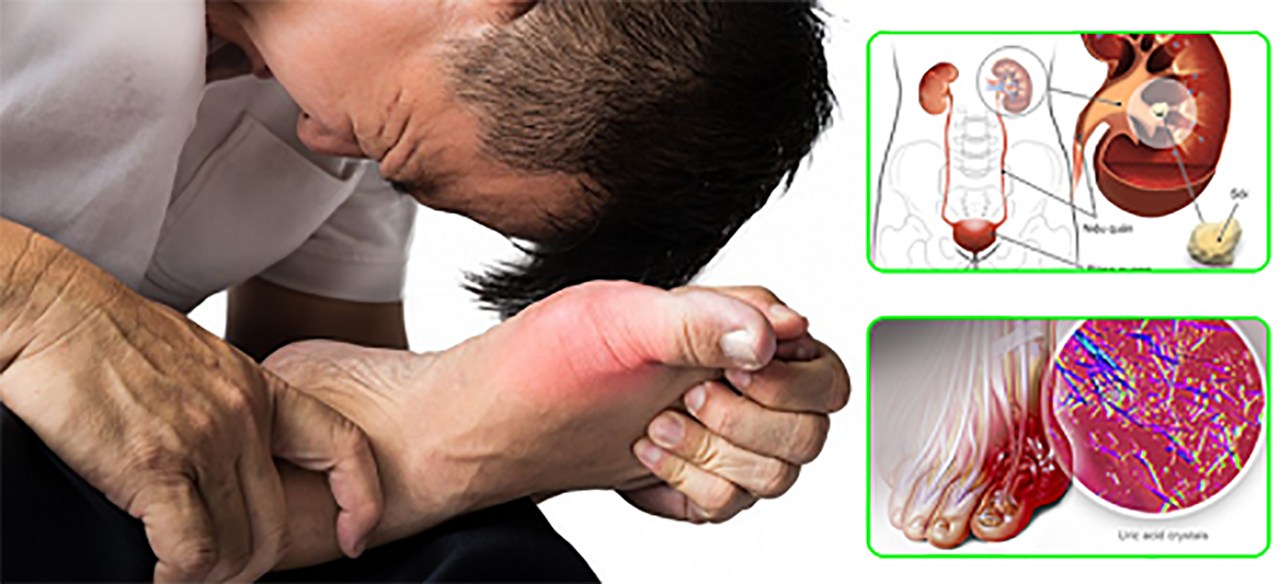 Bệnh gout ảnh hưởng thế nào đến tim, thận?- Ảnh 1. Bệnh gout ảnh hưởng thế nào đến tim, thận?- Ảnh 1.