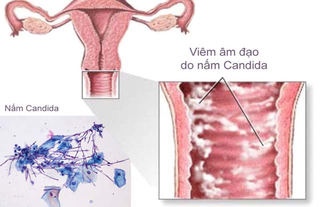 6 dấu hiệu cảnh báo nhiễm nấm âm đạo- Ảnh 1. 6 dấu hiệu cảnh báo nhiễm nấm âm đạo- Ảnh 1.