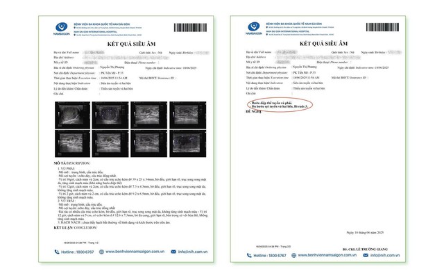Bóc u vú kết hợp đặt túi ngực- Ảnh 1. Bóc u vú kết hợp đặt túi ngực- Ảnh 1.