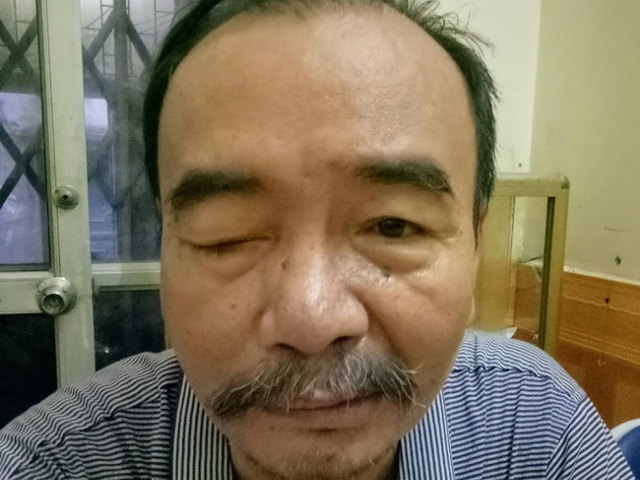 Phương pháp Đông y trong điều trị sụp mí mắt do liệt dây thần kinh số 3- Ảnh 1. Phương pháp Đông y trong điều trị sụp mí mắt do liệt dây thần kinh số 3- Ảnh 1.
