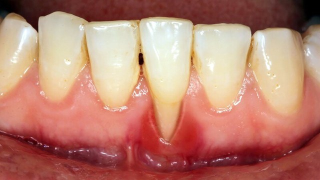 Ám ảnh tụt nướu: Dấu hiệu, nguyên nhân và 'lá chắn' bảo vệ nụ cười- Ảnh 1. Ám ảnh tụt nướu: Dấu hiệu, nguyên nhân và 'lá chắn' bảo vệ nụ cười- Ảnh 1.