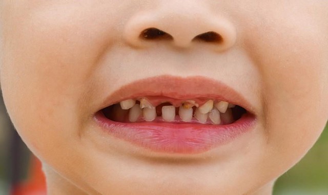 Bảo vệ những chiếc răng sữa xinh xắn: Tip bỏ túi cho phụ huynh- Ảnh 1. Bảo vệ những chiếc răng sữa xinh xắn: Tip bỏ túi cho phụ huynh- Ảnh 1.