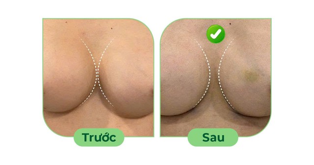 Điều trị ngực thông khe sau nâng ngực- Ảnh 1. Điều trị ngực thông khe sau nâng ngực- Ảnh 1.