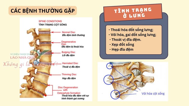 Phương pháp 'Khai thông cột sống' điều trị đau do thoái hóa khớp tại Lão Nhà Quê- Ảnh 1. Phương pháp 'Khai thông cột sống' điều trị đau do thoái hóa khớp tại Lão Nhà Quê- Ảnh 1.