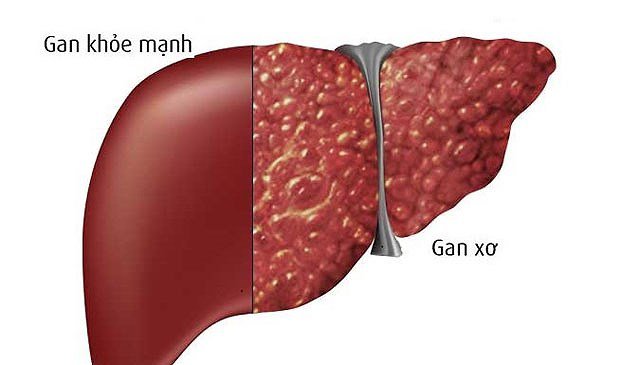 Xơ gan do rượu và các dấu hiệu cảnh báo cần biết- Ảnh 2. Xơ gan do rượu và các dấu hiệu cảnh báo cần biết- Ảnh 2.