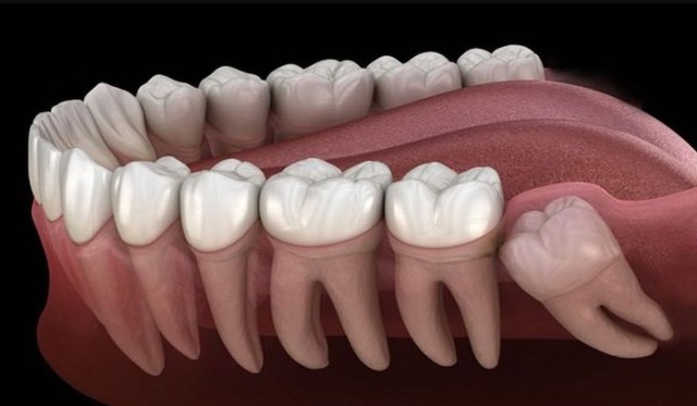 Sự thật ít ai biết về răng khôn không mọc- Ảnh 1. Sự thật ít ai biết về răng khôn không mọc- Ảnh 1.