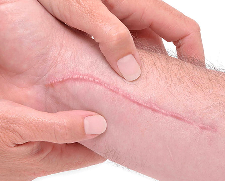 Kiêng gì để tránh bị sẹo lồi?- Ảnh 1. Kiêng gì để tránh bị sẹo lồi?- Ảnh 1.
