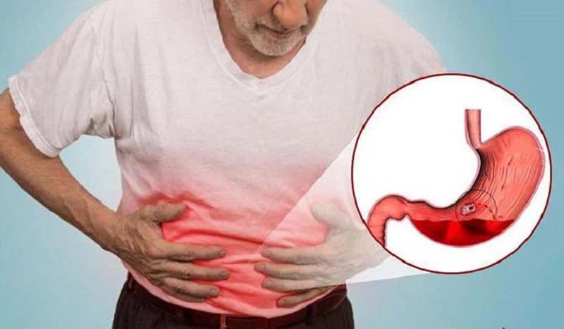 Nam bệnh nhân nguy kịch vì xuất huyết tiêu hóa và cách phát hiện bệnh sớm- Ảnh 1. Nam bệnh nhân nguy kịch vì xuất huyết tiêu hóa và cách phát hiện bệnh sớm- Ảnh 1.