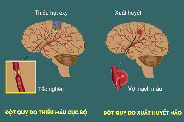 Nhồi máu não cấp do đâu?- Ảnh 1. Nhồi máu não cấp do đâu?- Ảnh 1.
