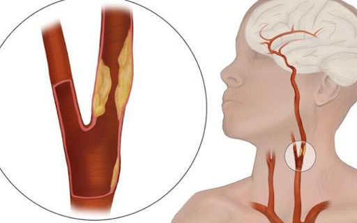 Hẹp động mạch cảnh có cần phẫu thuật không?- Ảnh 1. Hẹp động mạch cảnh có cần phẫu thuật không?- Ảnh 1.