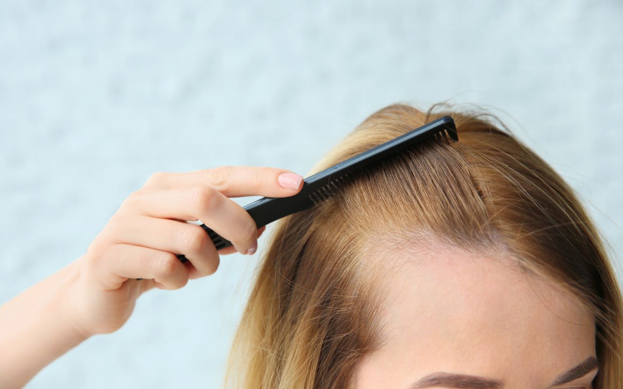 Dấu hiệu nhận biết sớm hói đầu và những lầm tưởng phổ biến- Ảnh 1. Dấu hiệu nhận biết sớm hói đầu và những lầm tưởng phổ biến- Ảnh 1.