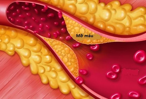 Mỡ máu cao không được chủ quan, kể cả người gầy- Ảnh 1. Mỡ máu cao không được chủ quan, kể cả người gầy- Ảnh 1.