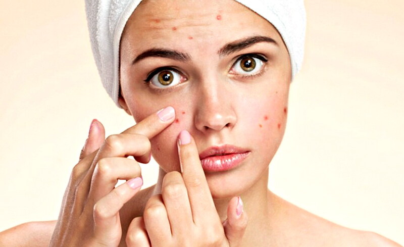 Cách xử lý mụn trứng cá, phục hồi làn da khỏe mạnh sau mụn- Ảnh 1. Cách xử lý mụn trứng cá, phục hồi làn da khỏe mạnh sau mụn- Ảnh 1.