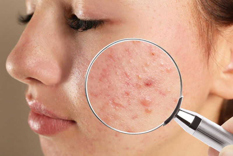 Bôi kem đánh răng có giúp điều trị mụn trứng cá?- Ảnh 2. Bôi kem đánh răng có giúp điều trị mụn trứng cá?- Ảnh 2.