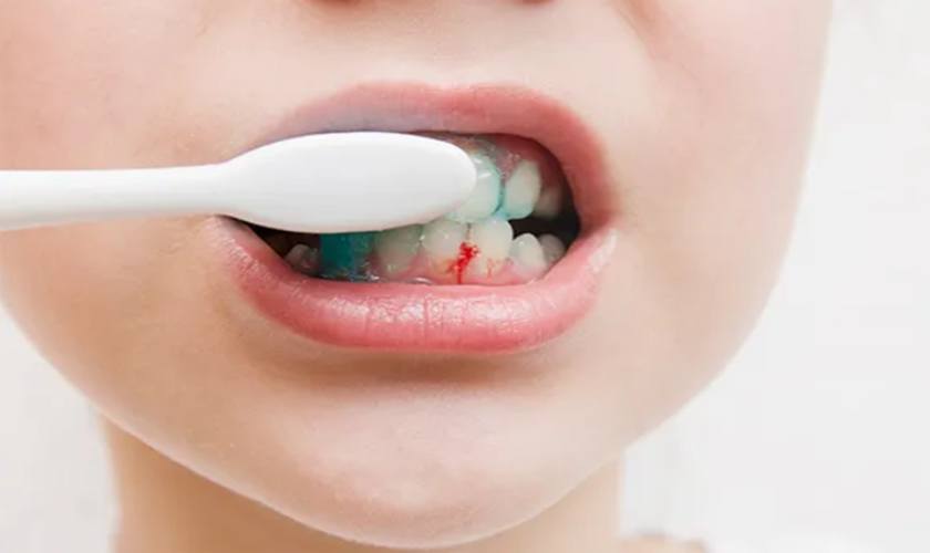 Chảy máu chân răng do đâu?- Ảnh 2. Chảy máu chân răng do đâu?- Ảnh 2.