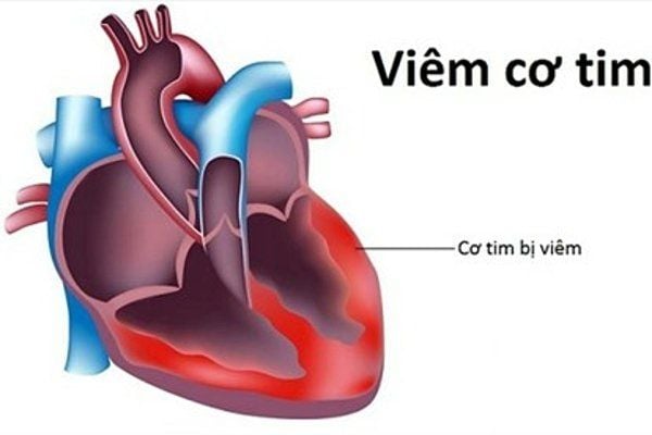 Biểu hiện của viêm cơ tim và các phương pháp điều trị- Ảnh 1. Chẩn đoán và điều trị viêm cơ tim | Vinmec