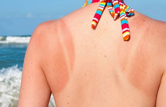 Cách phục hồi làn da sau rám nắng mùa hè - Ảnh 1. Cách phục hồi làn da sau rám nắng mùa hè - Ảnh 1.