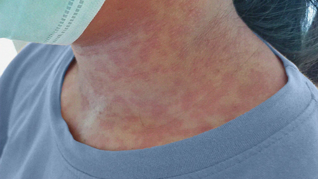 Nguy cơ mắc rubella: Cảnh báo với nhóm phụ nữ mang thai và trẻ nhỏ- Ảnh 1. Nguy cơ mắc rubella: Cảnh báo với nhóm phụ nữ mang thai và trẻ nhỏ- Ảnh 1.