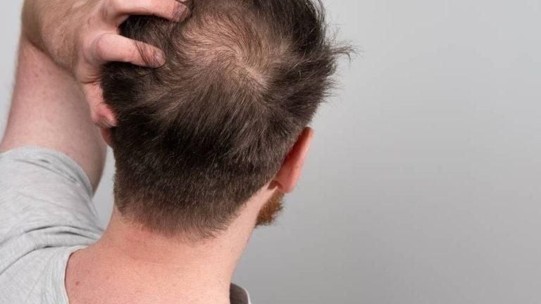 Dùng thuốc gây rụng tóc, chữa thế nào?- Ảnh 2. Dùng thuốc gây rụng tóc, chữa thế nào?- Ảnh 2.
