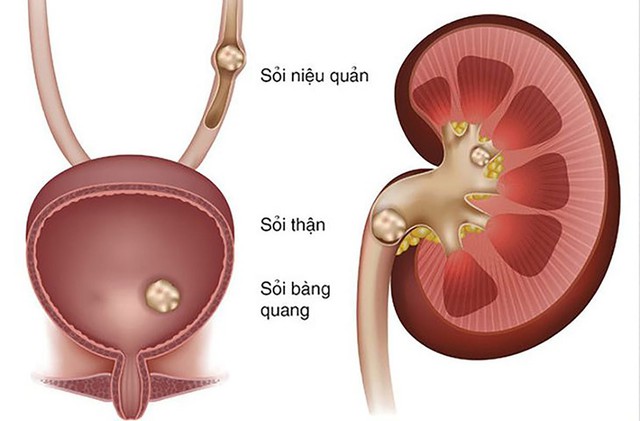 Cách ăn uống tốt nhất giúp ngăn ngừa hình thành sỏi thận- Ảnh 1. Cách ăn uống tốt nhất giúp ngăn ngừa hình thành sỏi thận- Ảnh 1.