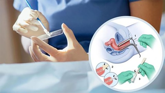 Cách tốt nhất để phát hiện sớm ung thư cổ tử cung- Ảnh 1. Cách tốt nhất để phát hiện sớm ung thư cổ tử cung- Ảnh 1.