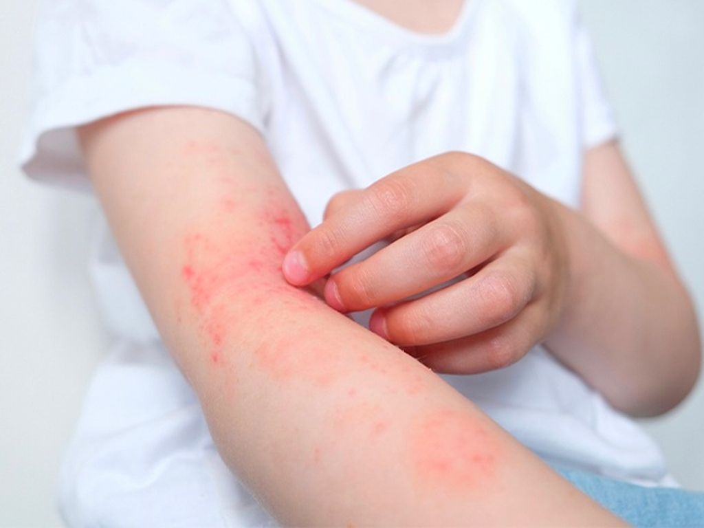 Bài thuốc điều trị viêm da cơ địa- Ảnh 1. Bài thuốc điều trị viêm da cơ địa- Ảnh 1.