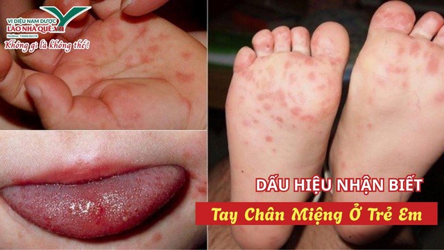Bệnh tay chân miệng ở trẻ và cách hỗ trợ chăm sóc từ thảo dược tự nhiên- Ảnh 1. Bệnh tay chân miệng ở trẻ và cách hỗ trợ chăm sóc từ thảo dược tự nhiên- Ảnh 1.