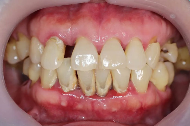 Viêm nha chu ở người cao tuổi: 'Rào cản' chất lượng cuộc sống- Ảnh 1. Viêm nha chu ở người cao tuổi: 'Rào cản' chất lượng cuộc sống- Ảnh 1.