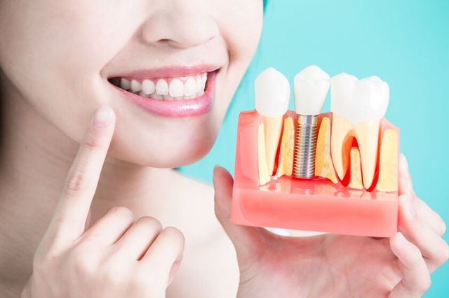 Chăm sóc nướu sau implant: Bảo vệ răng từ gốc- Ảnh 1. Chăm sóc nướu sau implant: Bảo vệ răng từ gốc- Ảnh 1.