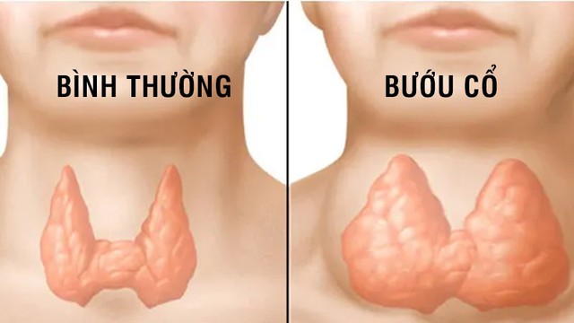 Thiếu i-ốt gây hại như thế nào?- Ảnh 1. Thiếu i-ốt gây hại như thế nào?- Ảnh 1.
