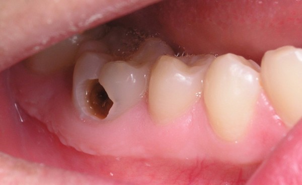 Nhận biết và đề phòng sâu răng ở trẻ- Ảnh 1. Nhận biết và đề phòng sâu răng ở trẻ- Ảnh 1.