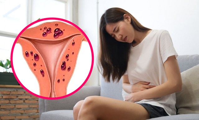 Lý do phụ nữ không nên chủ quan với lạc nội mạc tử cung- Ảnh 1. Lý do phụ nữ không nên chủ quan với lạc nội mạc tử cung- Ảnh 1.