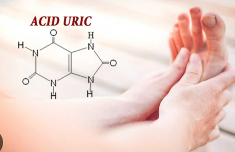 Acid uric cao gây hại như thế nào?- Ảnh 1. Acid uric cao gây hại như thế nào?- Ảnh 1.