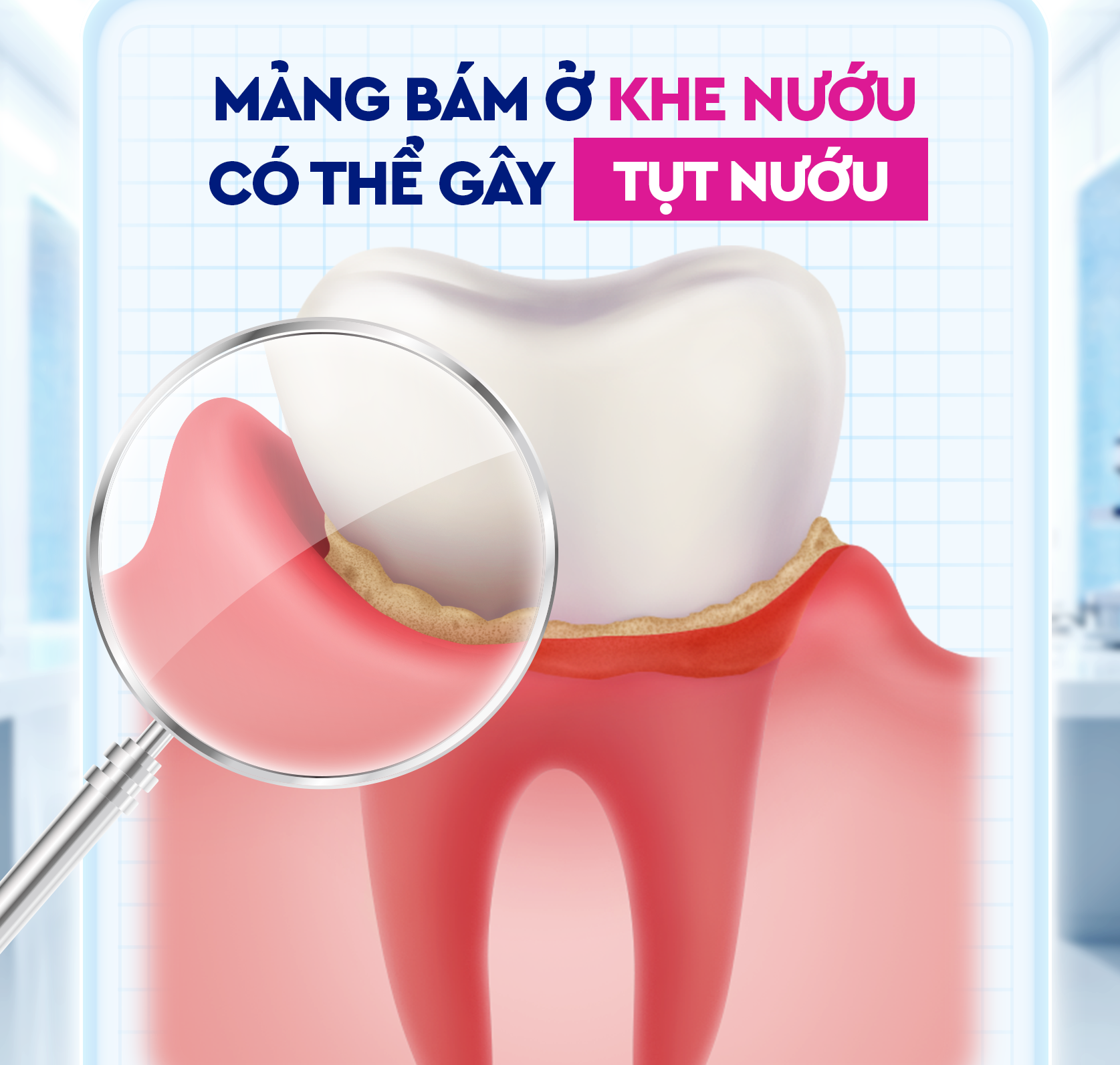 Bỏ quên khe nướu (lợi) - lý do đau răng, viêm nướu (lợi) kéo dài- Ảnh 1. Bỏ quên khe nướu (lợi) - lý do đau răng, viêm nướu (lợi) kéo dài- Ảnh 1.