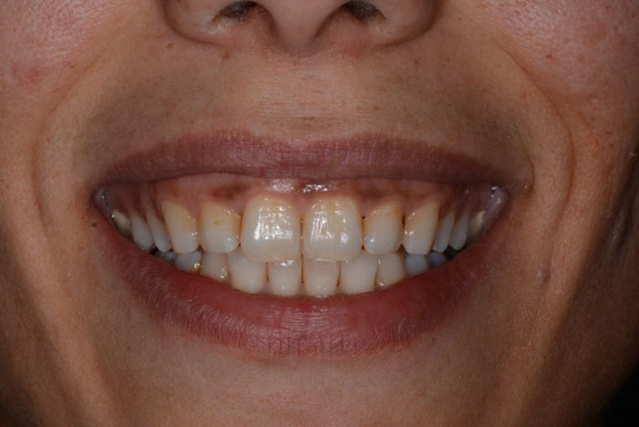 Muốn cười đẹp đừng bỏ quên nướu: Chăm đúng cách, nướu sẽ hồng!- Ảnh 1. Muốn cười đẹp đừng bỏ quên nướu: Chăm đúng cách, nướu sẽ hồng!- Ảnh 1.