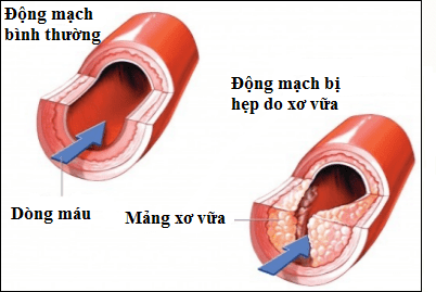 Xơ vữa động mạch: Bệnh lý nguy hiểm nhưng dễ bị bỏ qua- Ảnh 1. Xơ vữa động mạch: Bệnh lý nguy hiểm nhưng dễ bị bỏ qua- Ảnh 1.
